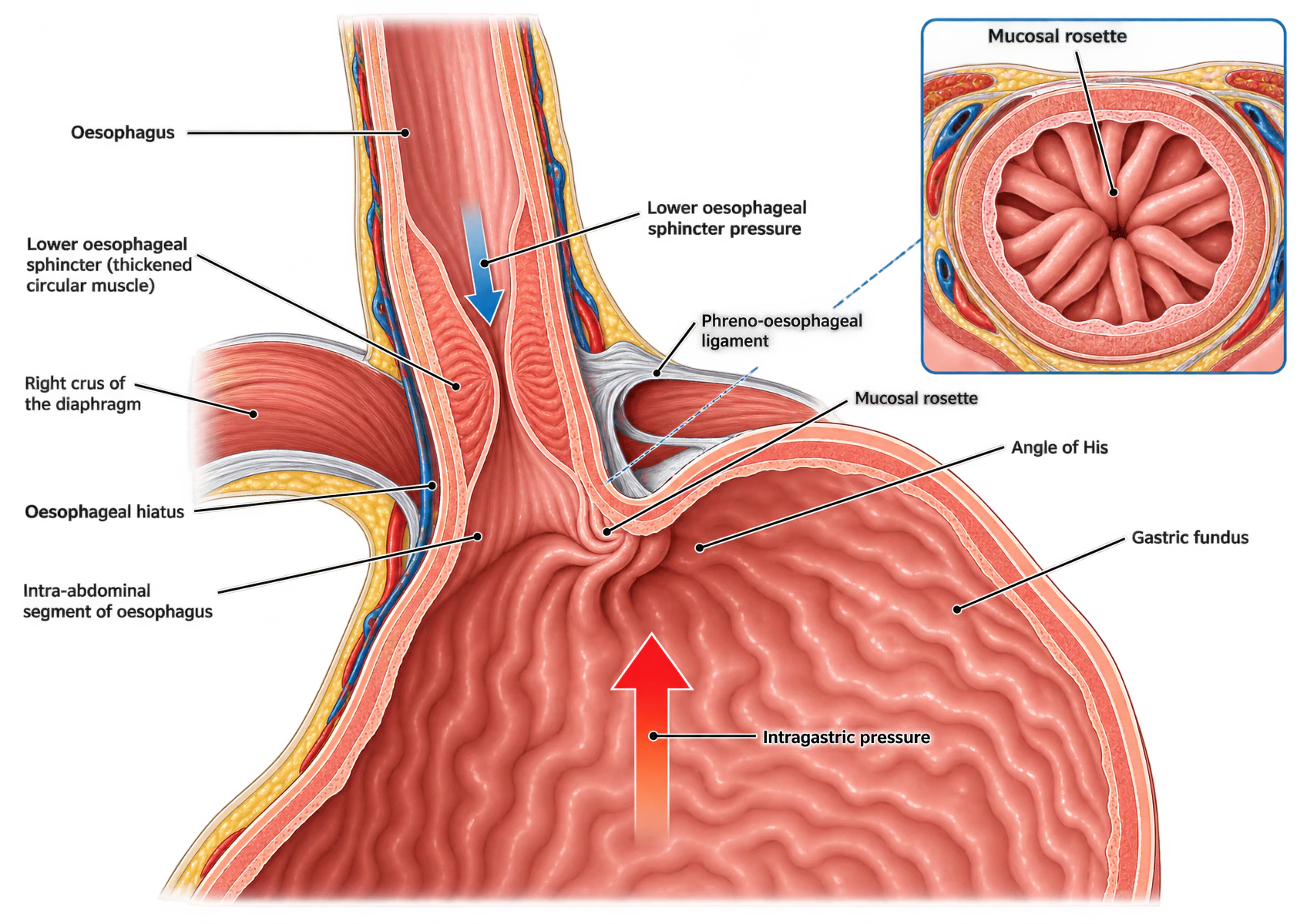 Coronal section of the gastro-oesophageal junction showing the oesophagus descending through the oesophageal hiatus, the right crus of the diaphragm encircling it, the phreno-oesophageal ligament anchoring it, the intra-abdominal segment of oesophagus, the angle of His where it meets the gastric fundus, and the mucosal rosette. A blue arrow marks lower oesophageal sphincter pressure acting downwards and a red arrow marks intragastric pressure acting upwards. An inset shows the mucosal rosette in cross-section.